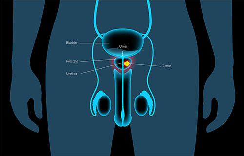 What is Rezūm minimally invasive steam injection therapy and how it treats BPH